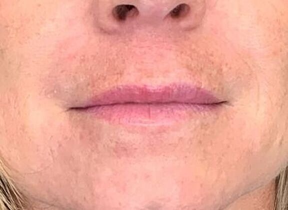 Dermal Filler Before & After