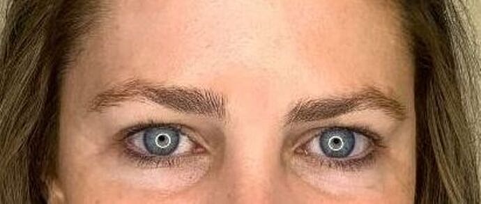Dermal Filler Before & After