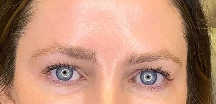 Dermal Filler Before & After