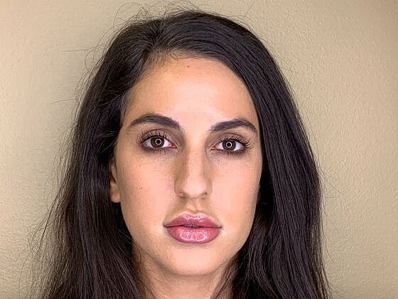 Dermal Filler Before & After