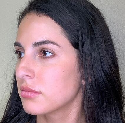 Dermal Filler Before & After