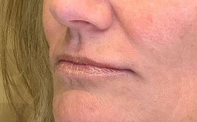 Dermal Filler Before & After