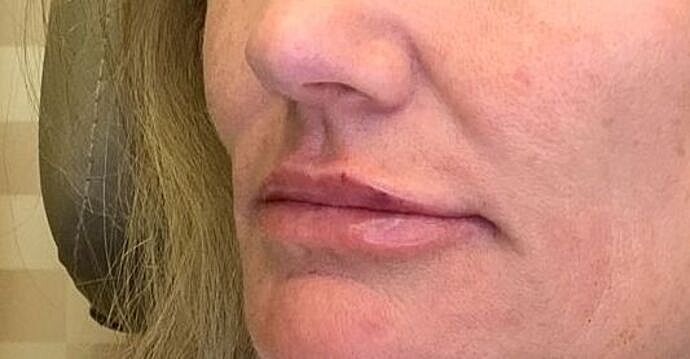 Dermal Filler Before & After