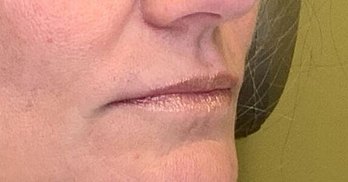 Dermal Filler Before & After