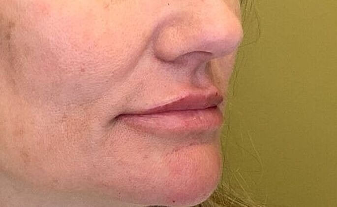 Dermal Filler Before & After