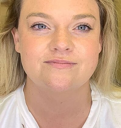 Dermal Filler Before & After