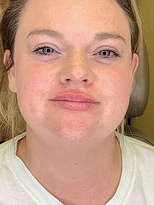 Dermal Filler Before & After