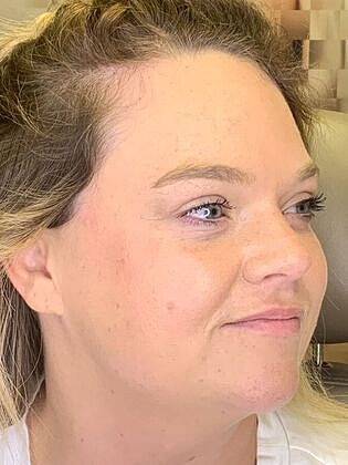 Dermal Filler Before & After