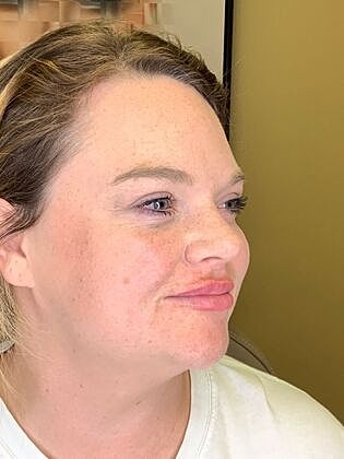 Dermal Filler Before & After