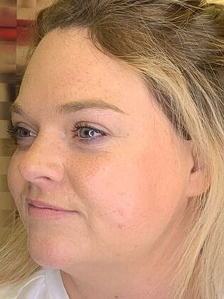 Dermal Filler Before & After