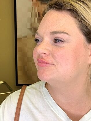 Dermal Filler Before & After