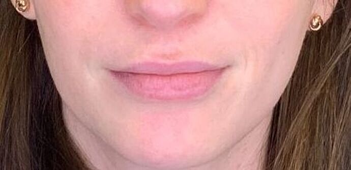 Dermal Filler Before & After