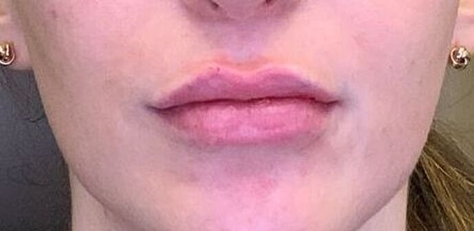 Dermal Filler Before & After