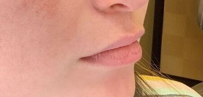 Dermal Filler Before & After