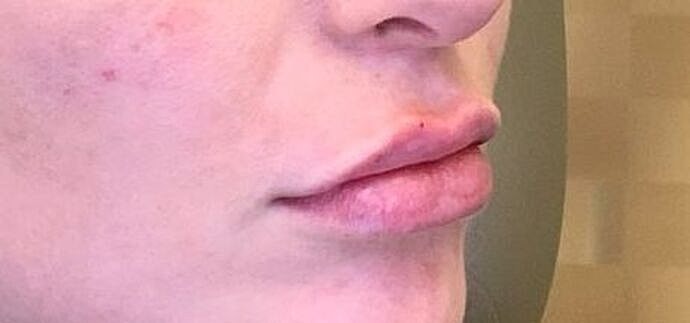 Dermal Filler Before & After