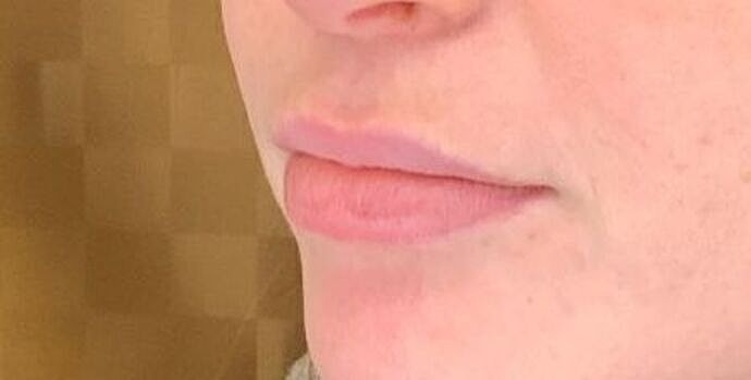 Dermal Filler Before & After