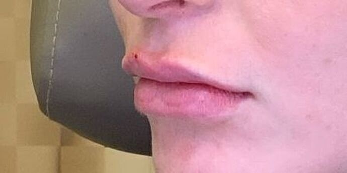 Dermal Filler Before & After