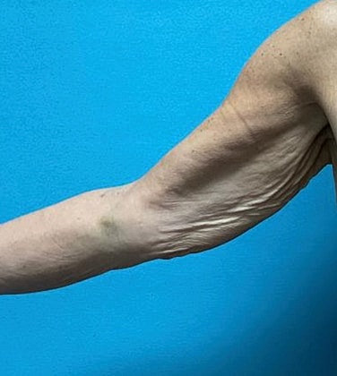 Arm Lift Before & After