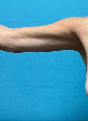 Arm Lift Before & After