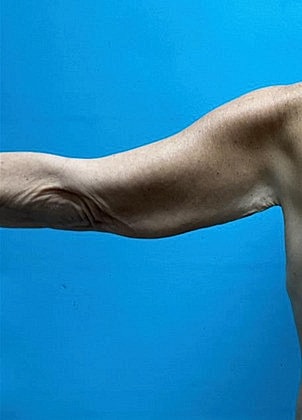 Arm Lift Before & After