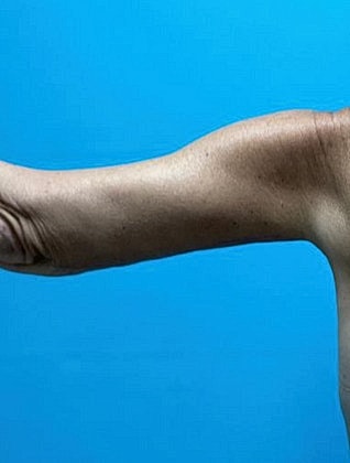Arm Lift Before & After