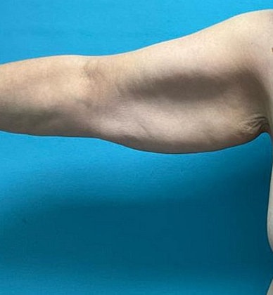 Arm Lift Before & After