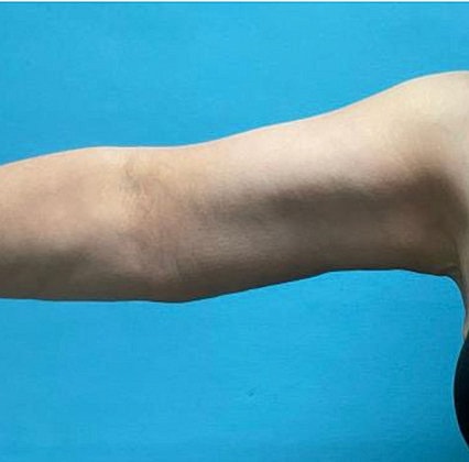 Arm Lift Before & After