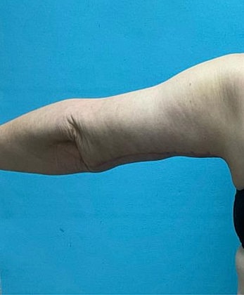 Arm Lift Before & After