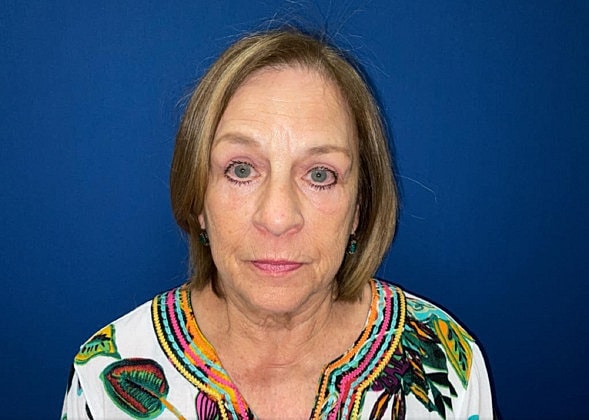 Laser Treatments Before & After