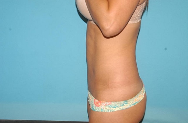 Liposuction Before & After
