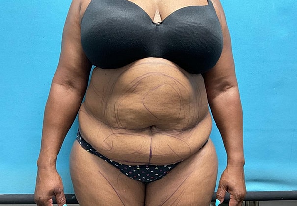 Liposuction Before & After
