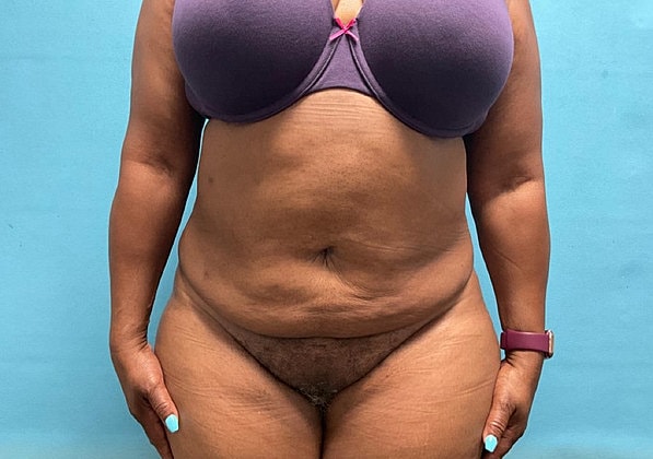Liposuction Before & After