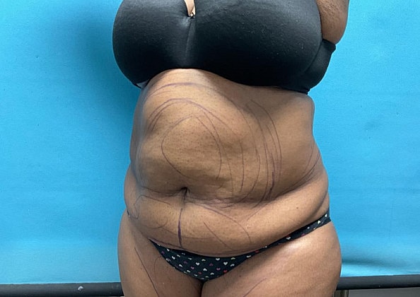 Liposuction Before & After