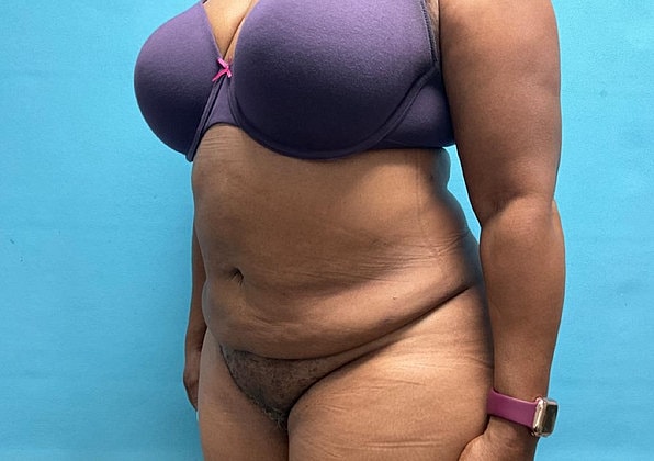 Liposuction Before & After