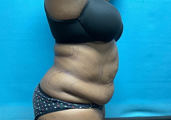Liposuction Before & After