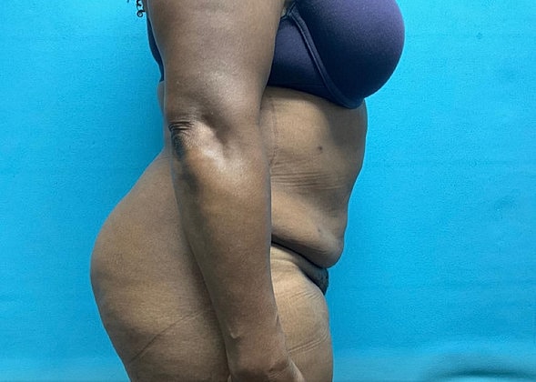 Liposuction Before & After