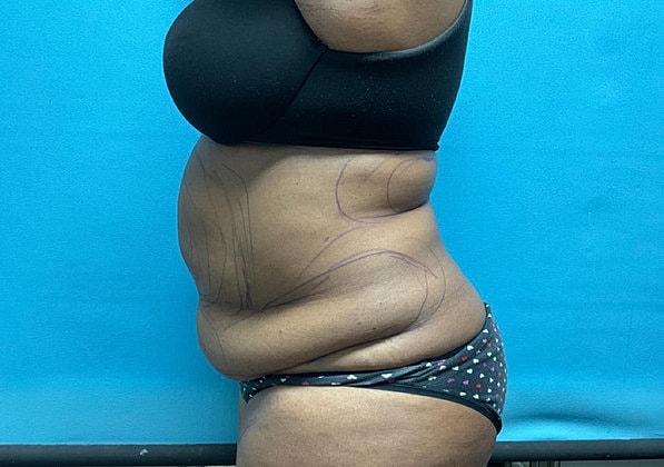 Liposuction Before & After