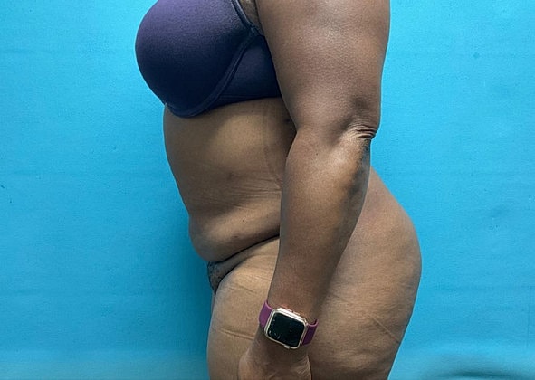 Liposuction Before & After