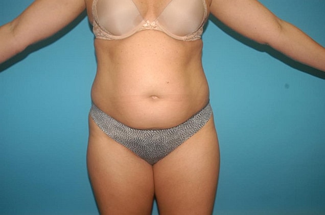Liposuction Before & After