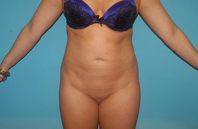 Liposuction Before & After