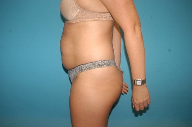 Liposuction Before & After