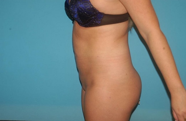 Liposuction Before & After