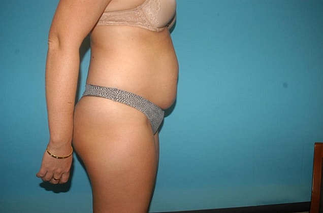Liposuction Before & After