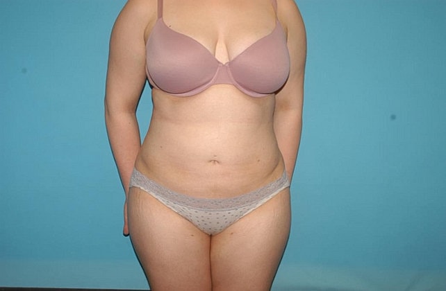 Liposuction Before & After