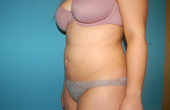 Liposuction Before & After