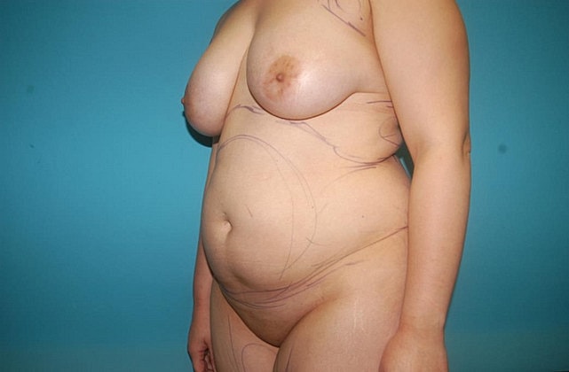 Liposuction Before & After