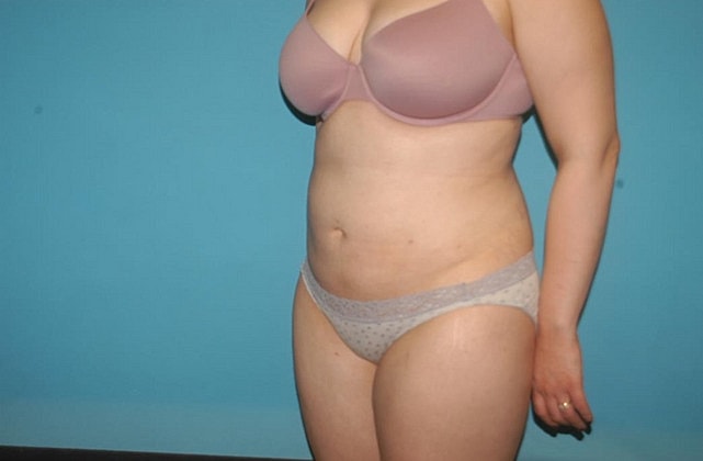Liposuction Before & After