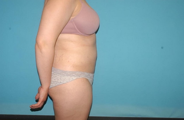 Liposuction Before & After