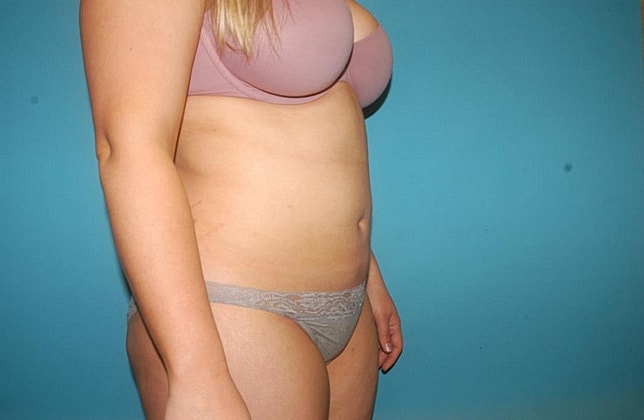 Liposuction Before & After