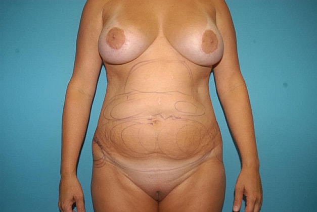 Liposuction Before & After